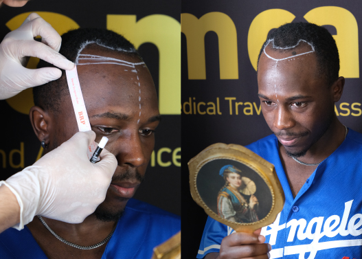 Why MCAN for Afro Hair Transplant