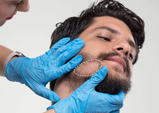 Why Should You Get Beard Hair Transplant in Turkey