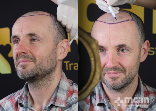 Why Should You Get Sapphire Hair Transplant in Turkey