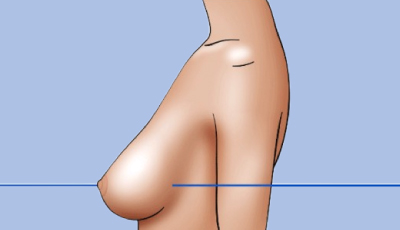 pseudo ptosis