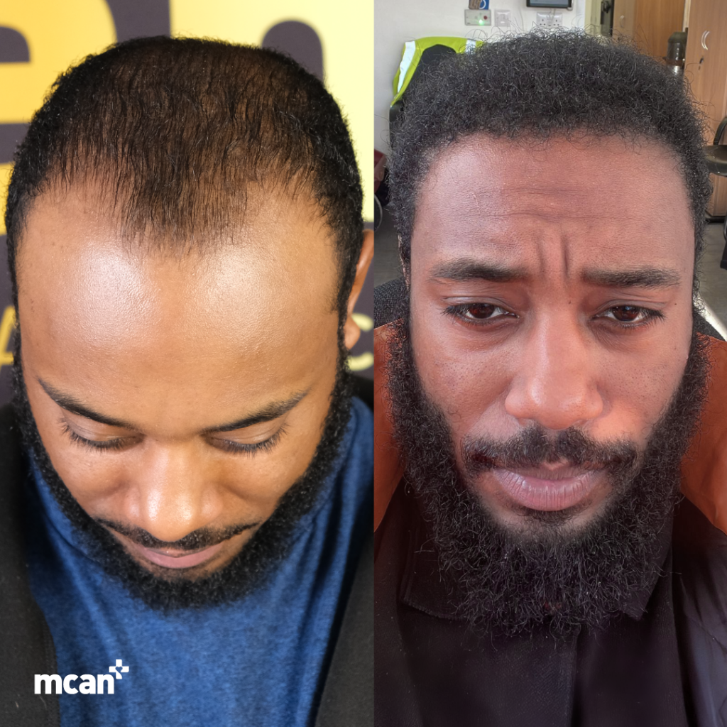 Afro Hair Transplant 4100 Grafts 9 Months Result