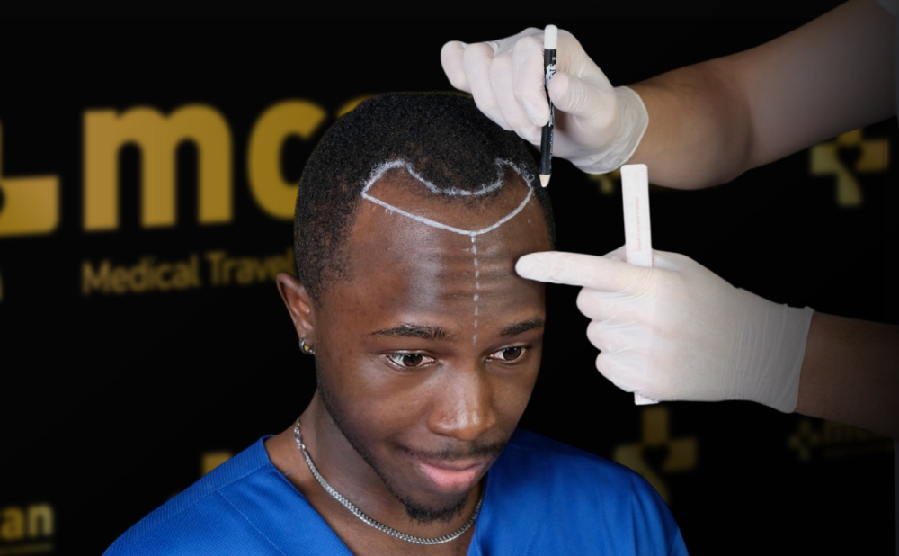 Afro Hair Transplant