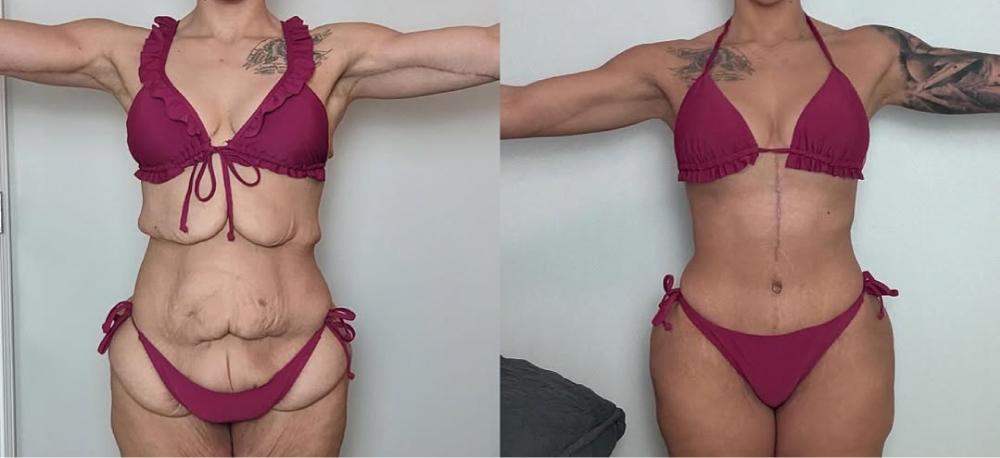 FDL Tummy Tuck Before After