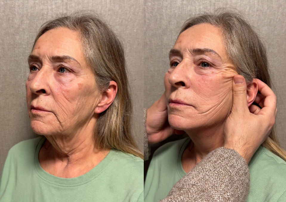 Full Facelift Rhytidectomy