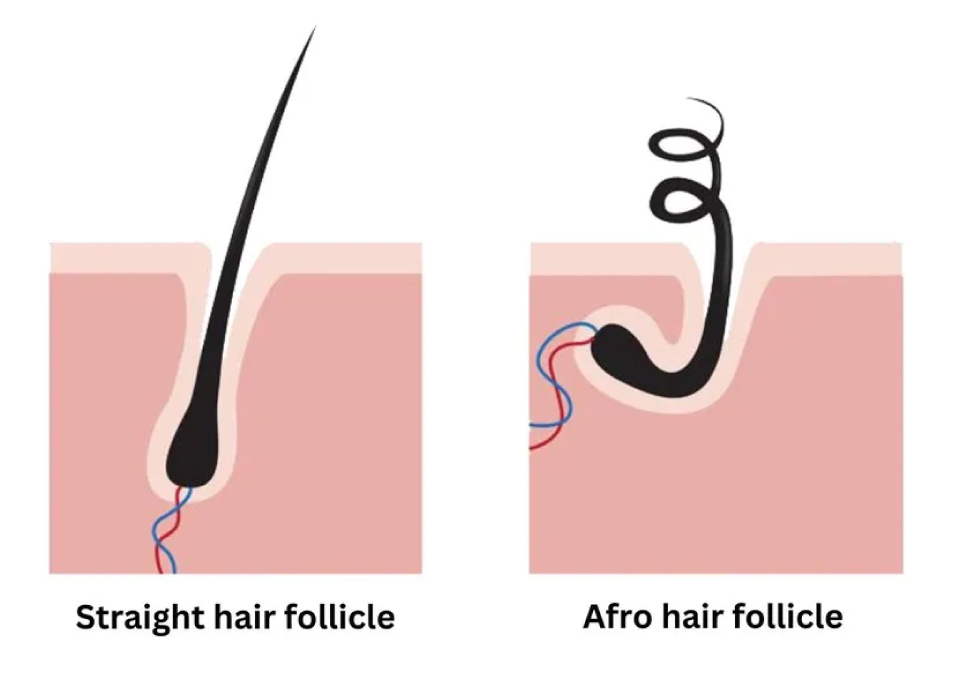 What Makes Afro Hair Unique for Transplants